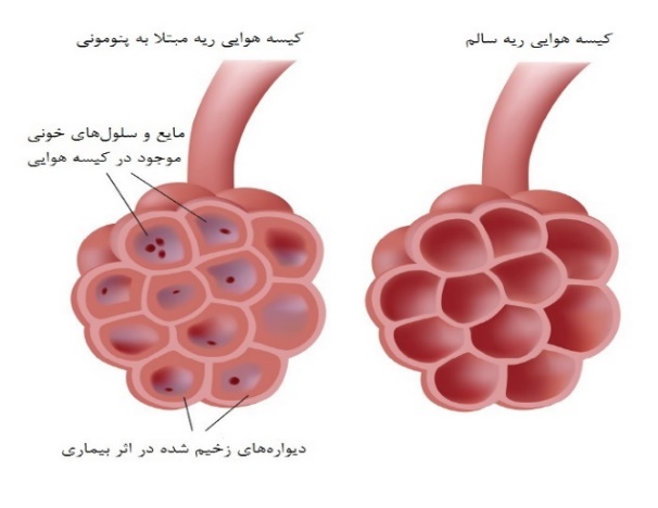 پنومونی ویروسی